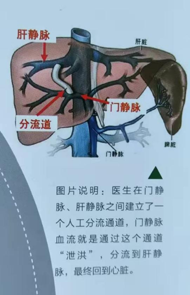 昆医大附二院11小时成功完成5例tips微创介入手术